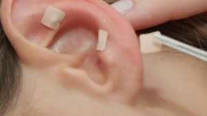 Auriculoterapia